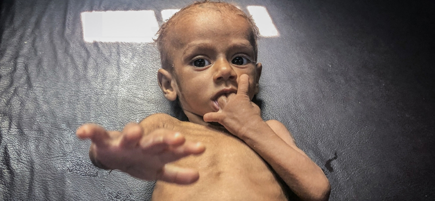 Yemen'de 20 milyon kişi açlıkla savaşıyor